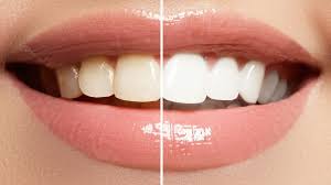 Teeth Whitening totkay in urdu