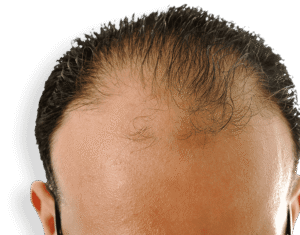 گنج پن کو دور کرنے کیلئے کیسٹر آئل کو استعمال کرنے کا صحیح طریقہ